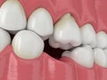3d render of teeth sliding towards the area of missing tooth in order to fill the gap