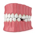 3d render of teeth sliding towards the area of missing tooth in order to fill the gap