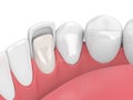 3d render of teeth with veneer Royalty Free Stock Photo