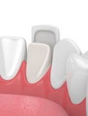 3d render of teeth with veneer Royalty Free Stock Photo