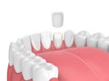 3d render of teeth with veneer