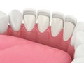 3d render of teeth with veneers Royalty Free Stock Photo