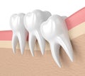 3d render of teeth with wisdom crowding Royalty Free Stock Photo