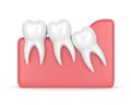 3d render of teeth with wisdom crowding