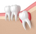 3d render of teeth with wisdom cyst