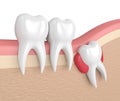 3d render of teeth with wisdom cyst