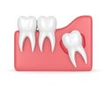 3d render of teeth with wisdom cyst