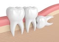 3d render of teeth with wisdom horizontal impaction Royalty Free Stock Photo