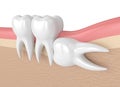 3d render of teeth with wisdom horizontal impaction Royalty Free Stock Photo