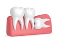 3d render of teeth with wisdom horizontal impaction Royalty Free Stock Photo