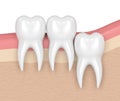 3d render of teeth with wisdom vertical impaction Royalty Free Stock Photo