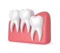 3d render of teeth with wisdom vertical impaction Royalty Free Stock Photo
