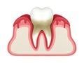 3d render of tooth in bleeding gums