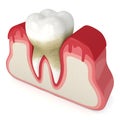 3d render of tooth in bleeding gums