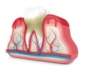 3d render of tooth in bleeding gums