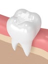 3d render of tooth with dental composite filling