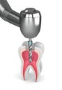 3d render of tooth with dental drill