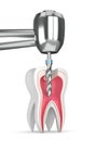 3d render of tooth with dental drill