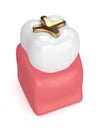 3d render of tooth with dental golden inlay filling