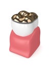 3d render of tooth with dental golden onlay filling