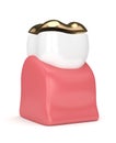 3d render of tooth with dental golden onlay filling