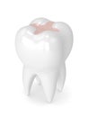 3d render of tooth with dental inlay filling