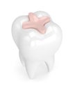 3d render of tooth with dental inlay filling