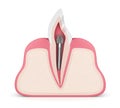 3d render of tooth with dental metal post