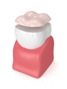 3d render of tooth with dental onlay filling Royalty Free Stock Photo