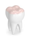 3d render of tooth with dental onlay filling Royalty Free Stock Photo