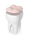 3d render of tooth with dental onlay filling Royalty Free Stock Photo