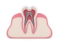 3d render of tooth with dental root canal posts