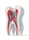 3d render of tooth with dental root canal posts