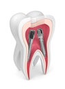 3d render of tooth with dental root canal posts