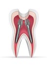 3d render of tooth with dental root canal posts