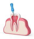 3d render of tooth with endodontic file in gums