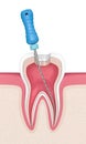 3d render of tooth with endodontic file in gums