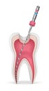 3d render of tooth with endodontic file