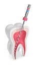 3d render of tooth with endodontic file