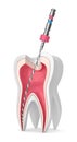 3d render of tooth with endodontic file