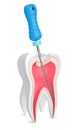 3d render of tooth with endodontic file