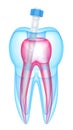 3d render of tooth with fiber post over white Royalty Free Stock Photo