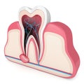 3d render of tooth in gums with cyst Royalty Free Stock Photo