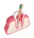 3d render of tooth in gums with gutta percha Royalty Free Stock Photo