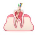 3d render of tooth in gums with gutta percha Royalty Free Stock Photo