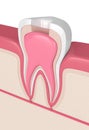 3d render of tooth with root canal treatment procedure Royalty Free Stock Photo