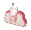 3d render of tooth with gutta percha, fiber post and filling Royalty Free Stock Photo