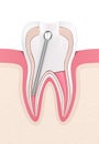 3d render of tooth with stainless steel dental post and filling