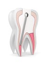 3d render of tooth with stainless steel dental post and filling