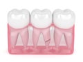 3d render of translucent gums with cracked tooth root